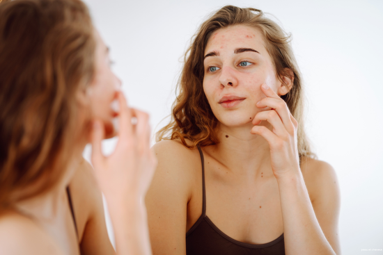 peau acné visage